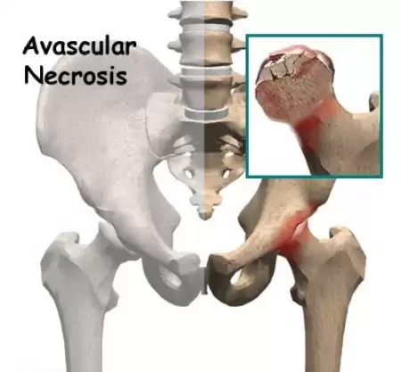 avascular necrosis-AVN