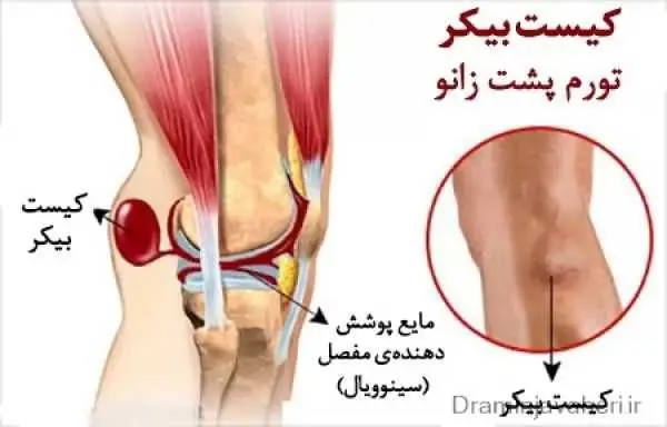 کیست بیکر چیست؟   